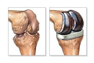 заміна колінного суглоба при артрозі