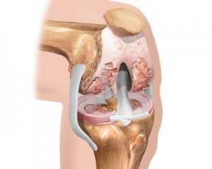 початкова стадія колінного артрозу
