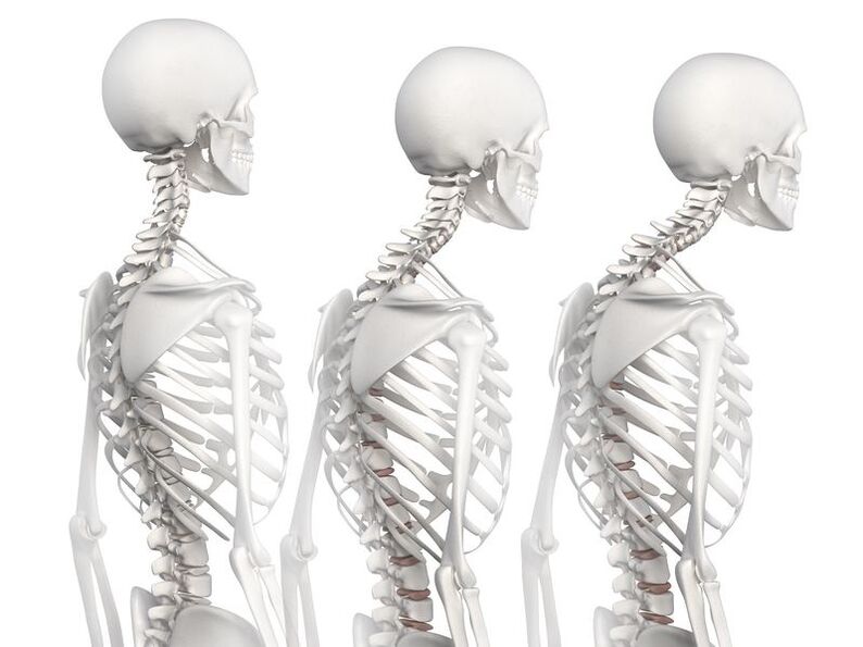 Ступені розвитку грудного остеохондрозу на прикладі моделі скелета